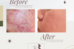 Microneedling