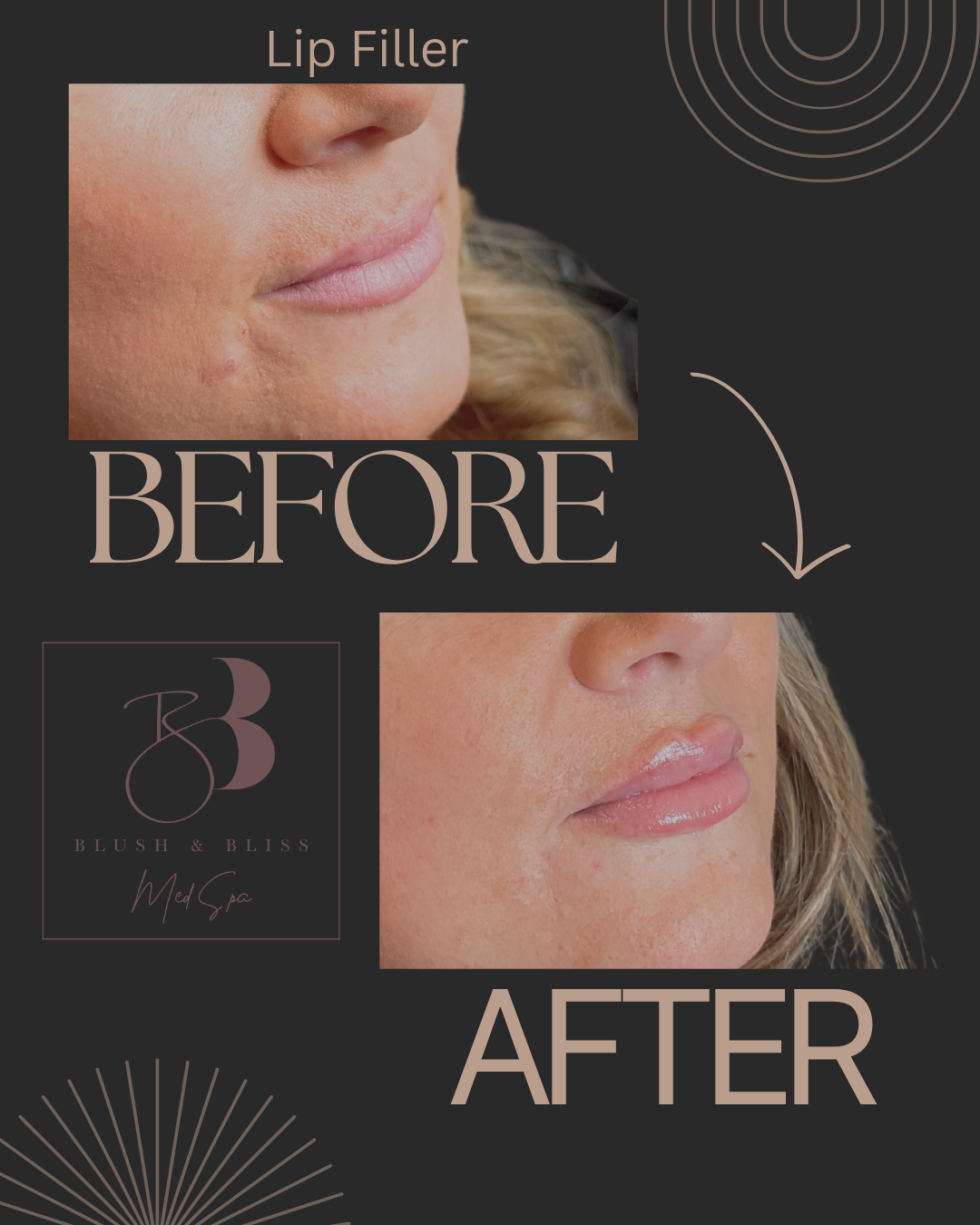 Lip Filler
