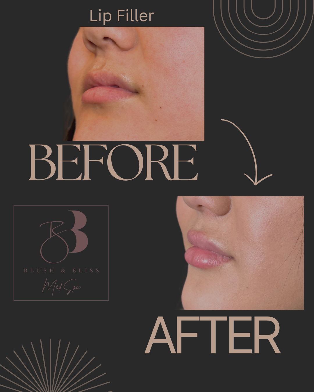 Lip Filler