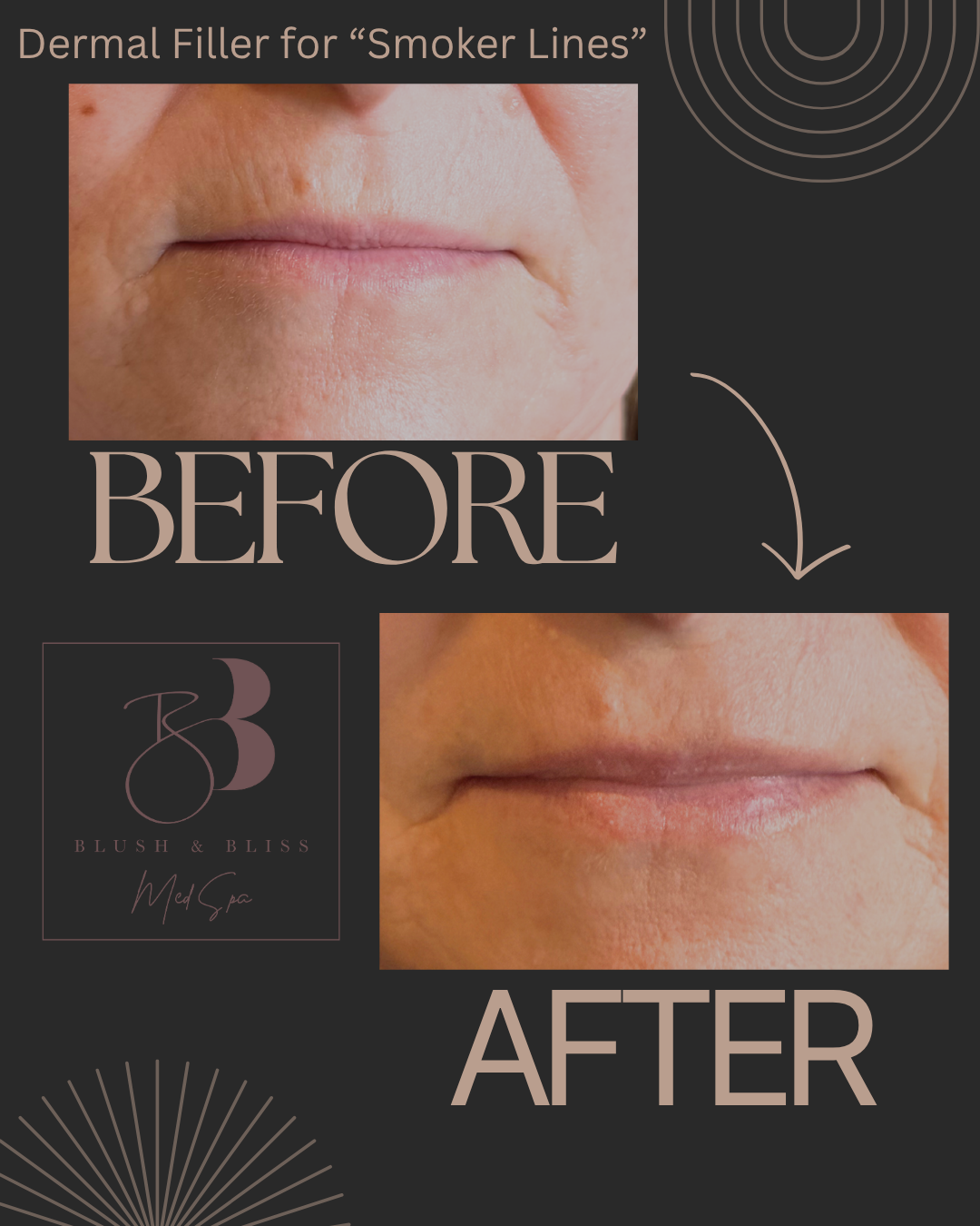 Dermal Filler