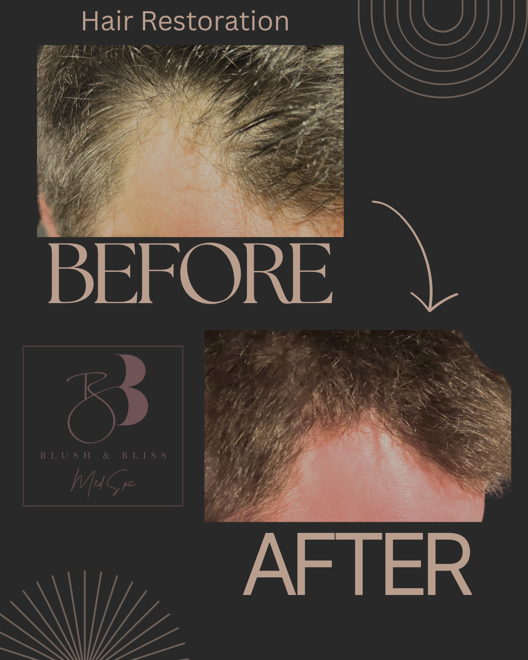 Hair Restoration