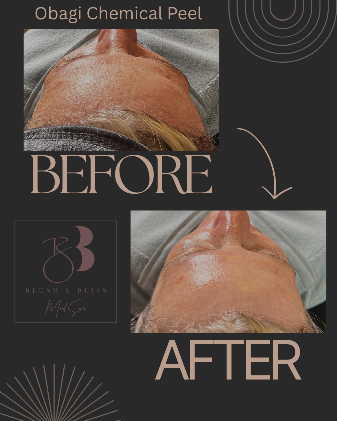Chemical Peel