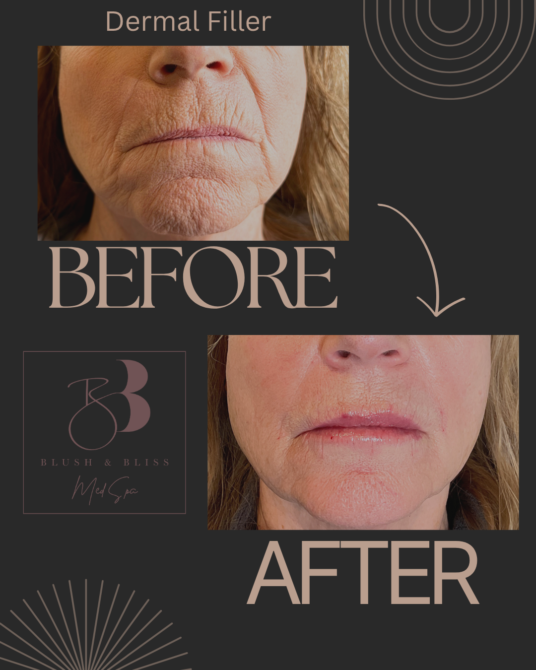 Dermal Filler