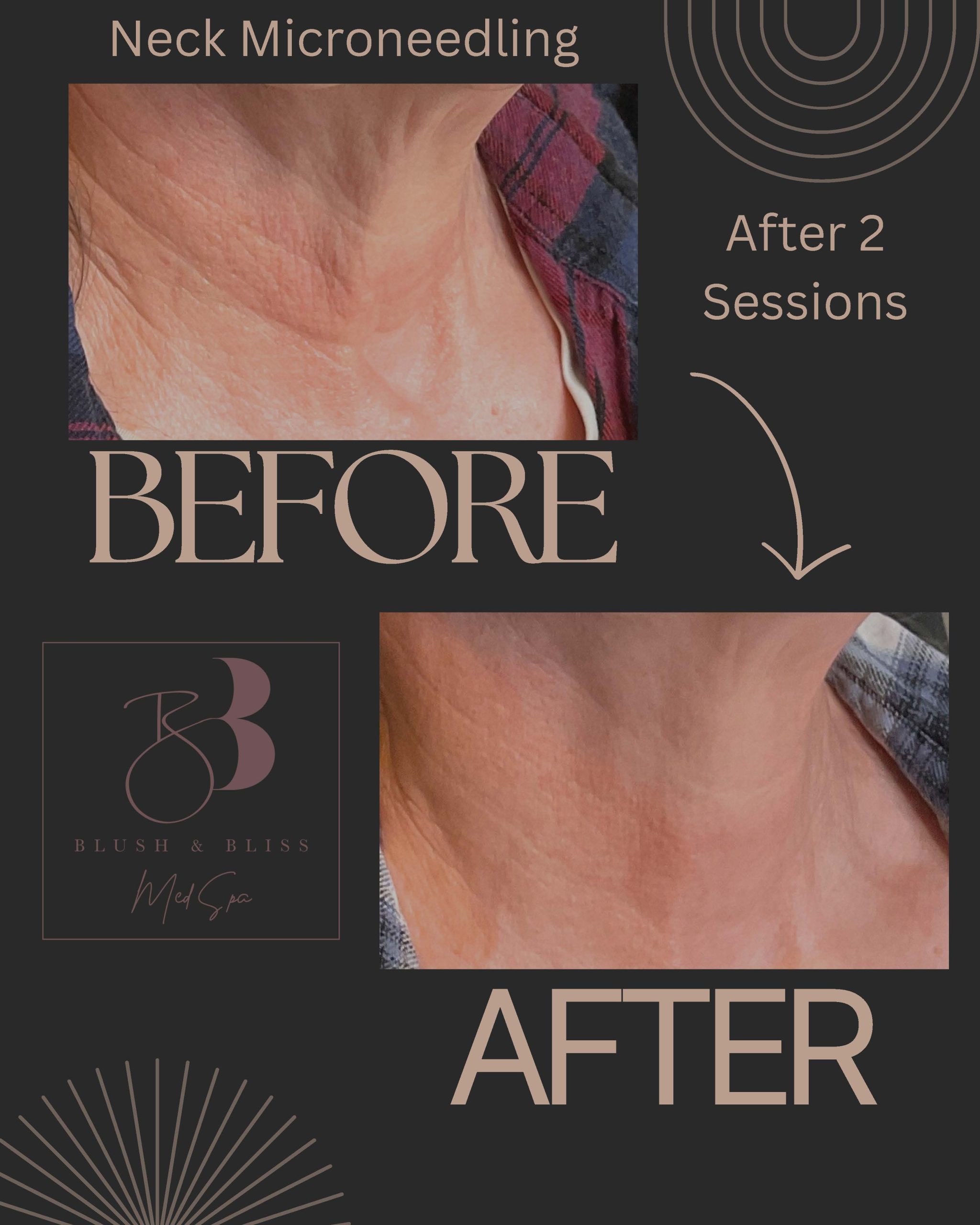 Neck Microneedling